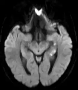 Description de l'image Transiente globale Amnesie MRT DWI axial.png.