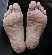 Peau de la plante des pieds hyperhydratée par un séjour dans l'eau.