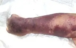 Description de l'image Trombocitopenia 01.JPG.