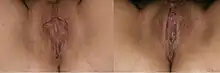 Deux photos avant et après une opération de vaginoplastie