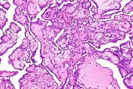 cellules de mésothéliome.