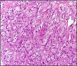 Description de l'image Xanthoma10X.jpg.
