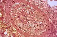 Hyphes dans un vaisseau sanguin (vue en coupe).