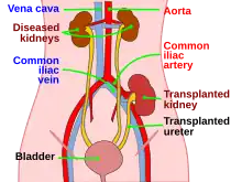 Description de l'image kidtransplant.svg.
