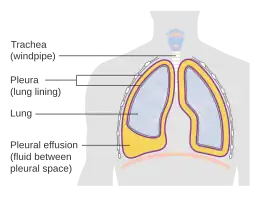 Description de l'image Diagram showing a build up of fluid in the lining of the lungs (pleural effusion) CRUK 054.svg.